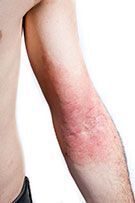 eczema