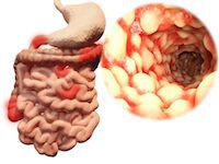 Inflammatory Bowel Diesease